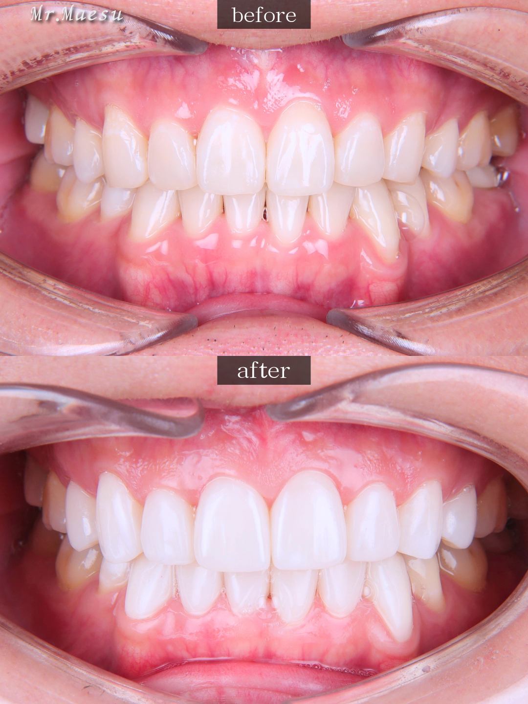 まえす様 正面 Before/After