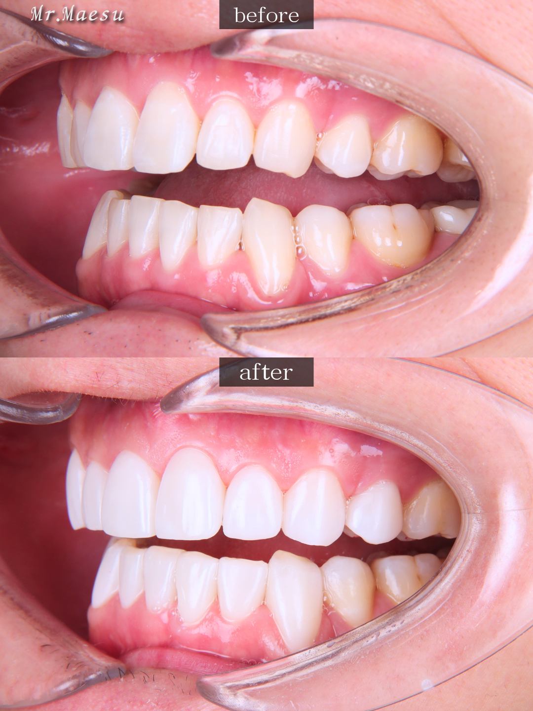 まえす様 左側面 Before/After