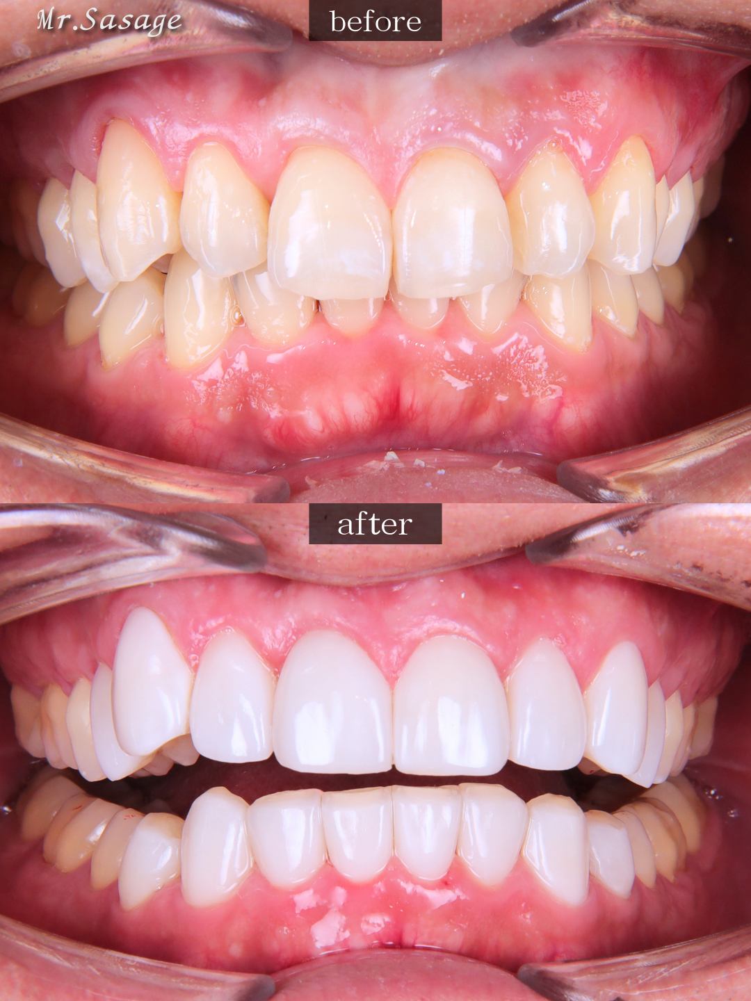 捧様 正面開口 Before/After