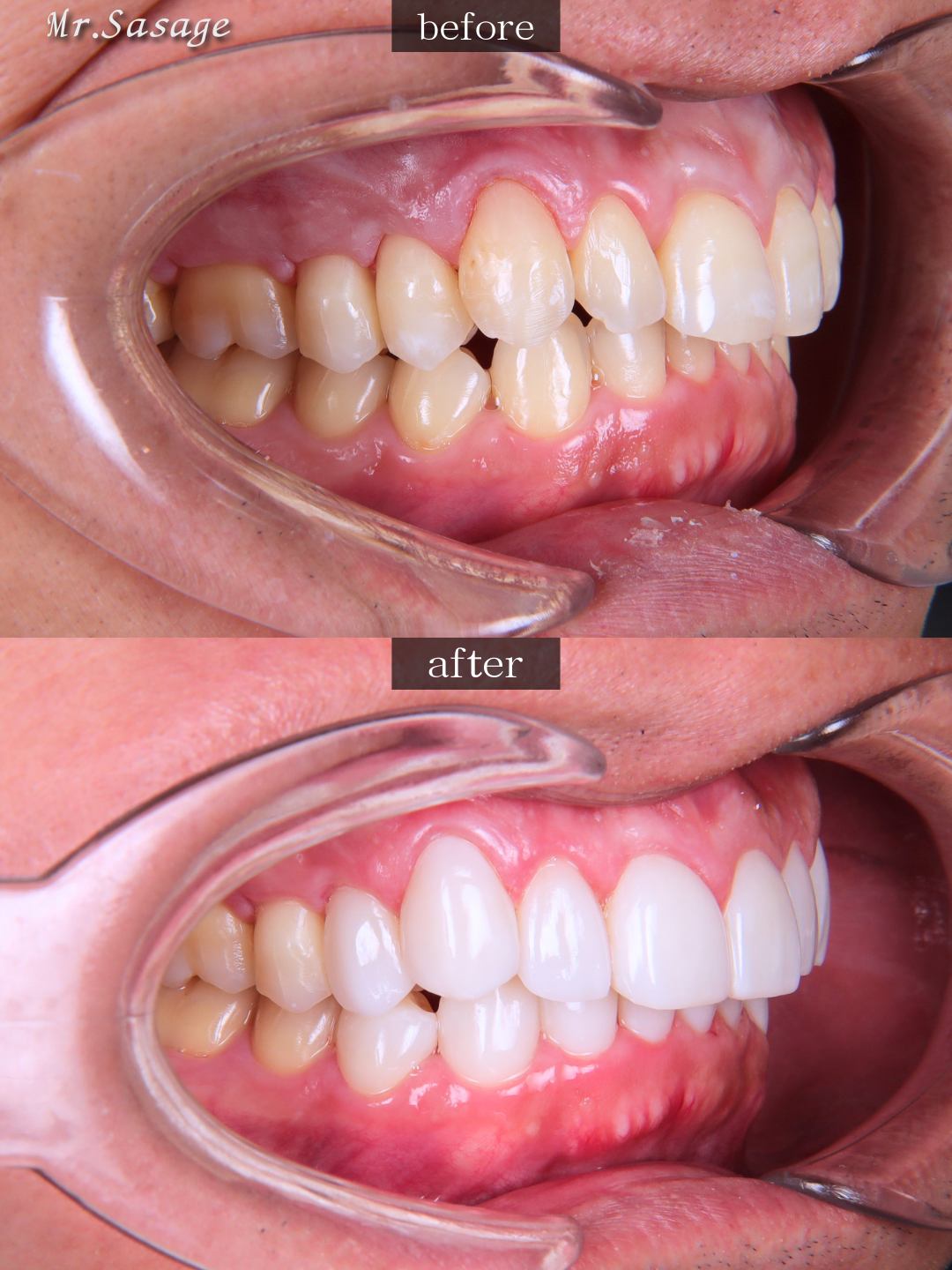 捧様 右側面 Before/After